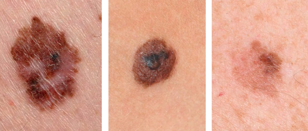 Tre stycken olika bilder på malignt melanom.